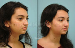 Rhinoplasty Results Dallas