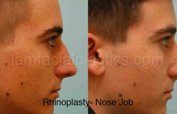Rhinoplasty Before and After Photos
