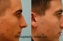 Rhinoplasty Results Dallas