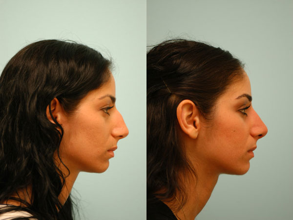 middle-eastern-rhinoplasty