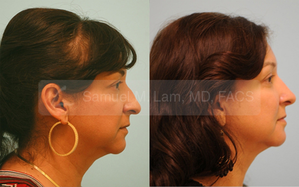 mestizo nose job