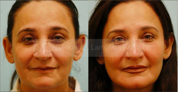 Bottom Nose Mole Removal