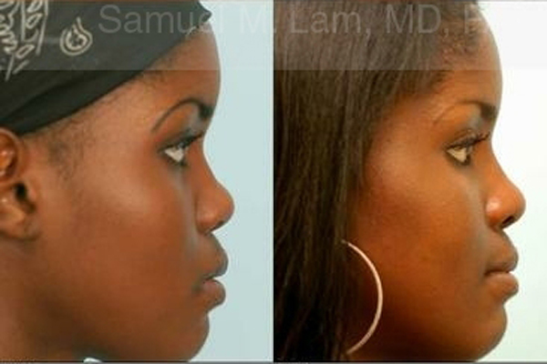 Women Nose Job Results Dallas