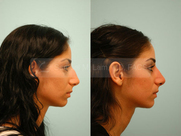 middle eastern nose surgery