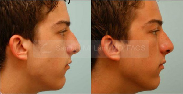 Male Rhinoplasty Results Dallas