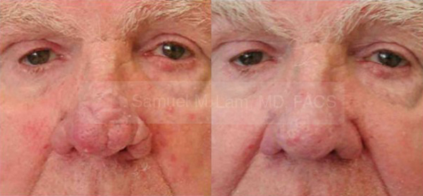 Aging Nose Rhinoplasty Aging Nose Rhinoplasty Dallas
