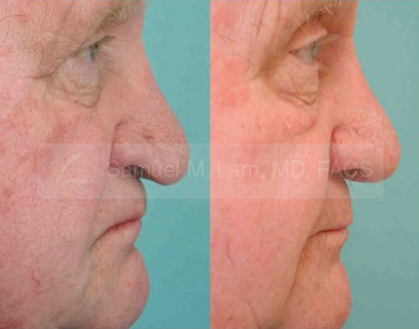 Aging Nose Rhinoplasty Results Dallas