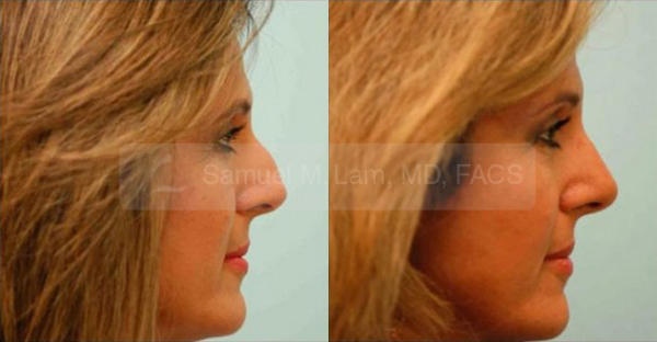 Women Nose Job Results Dallas