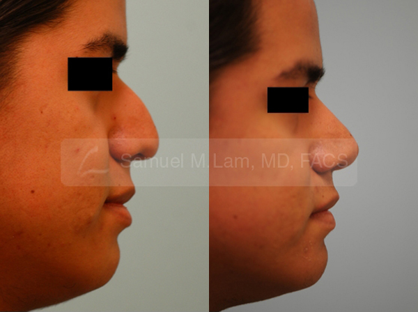 Hispanic Rhinoplasty hispanic rhinoplasty