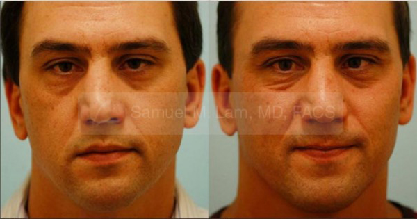 trauma rhinoplasty