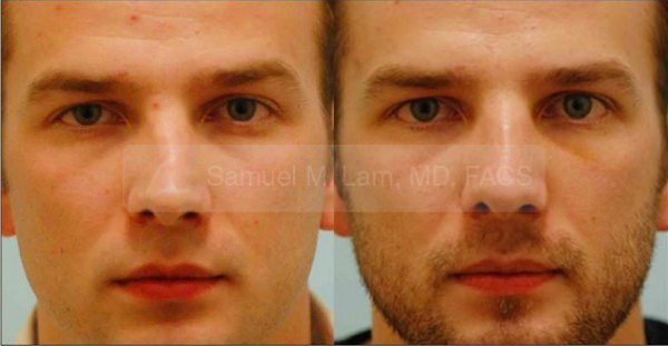 deviated nasal septum surgery