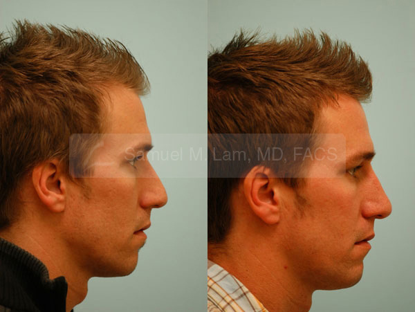 Male Rhinoplasty Results Dallas