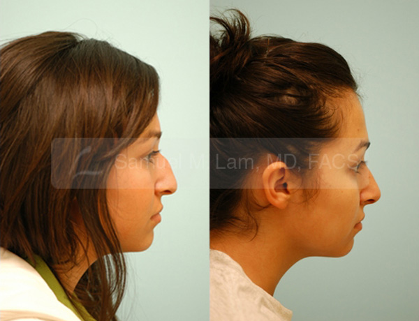 Female Rhinoplasty Results Dallas