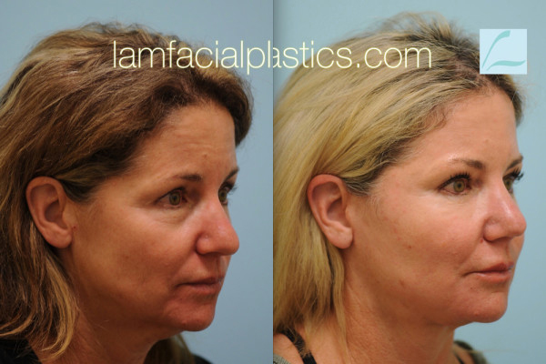 Aging Nose Rhinoplasty Aging Nose Job Dallas