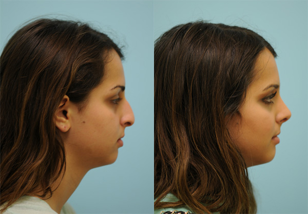 Female Rhinoplasty Results Dallas