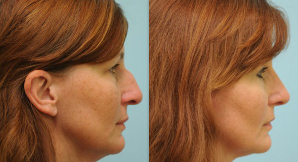 caucasian_rhinoplasty