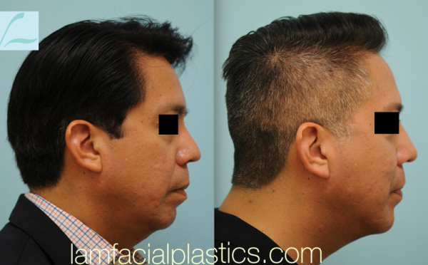 Male Rhinoplasty Results Dallas