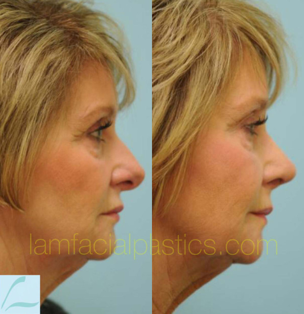 Revision Rhinoplasty