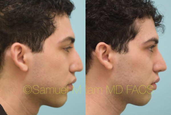 middle-eastern-rhinoplasty