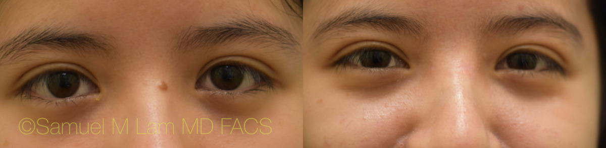 Mole Removal on the Nose Mole Removal on the Nose