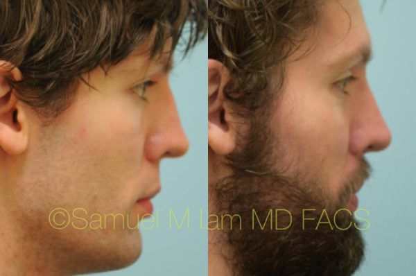 Rhinoplasty Deformities Repair