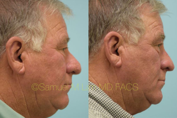 Aging Nose Rhinoplasty Results Dallas