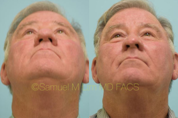 Aging Nose Rhinoplasty Results Dallas