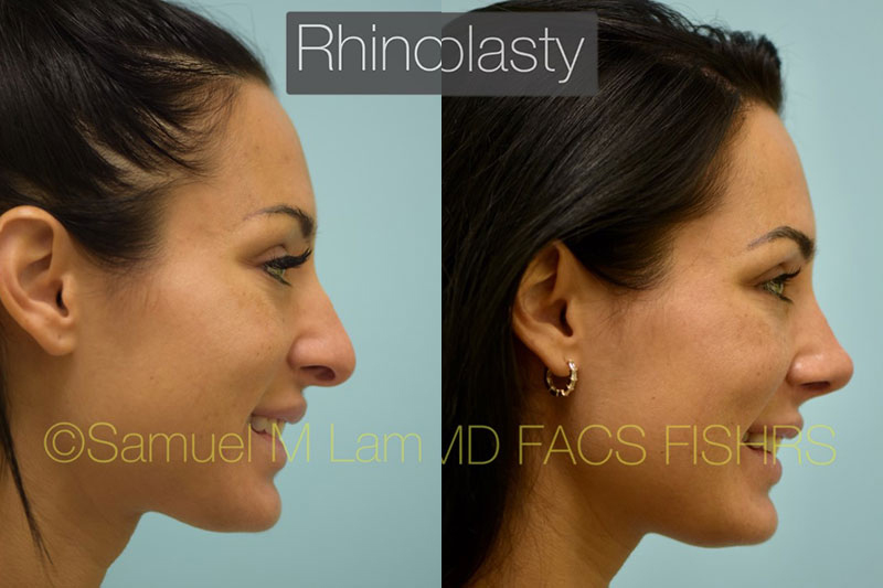 Traumatic Nose Rhinoplasty Photos