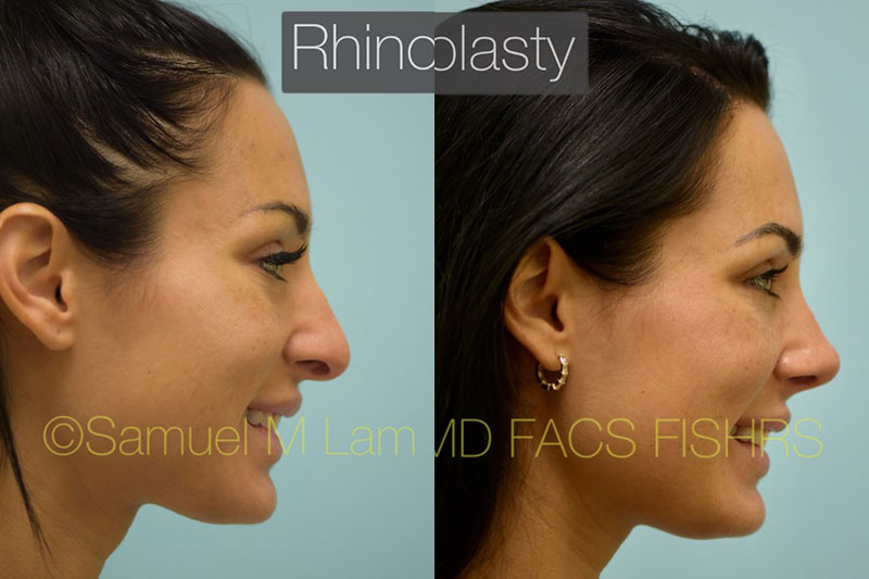 Rhinoplasty Results Dallas