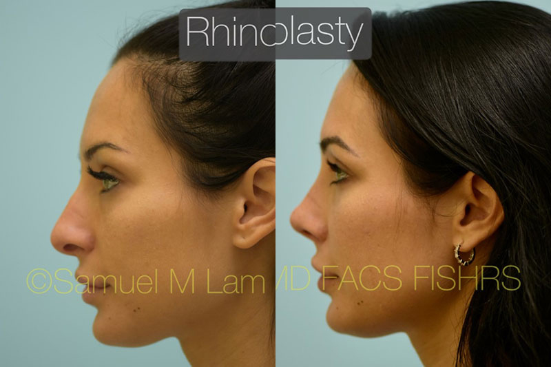 Nasal Tip Rhinoplasty Photos