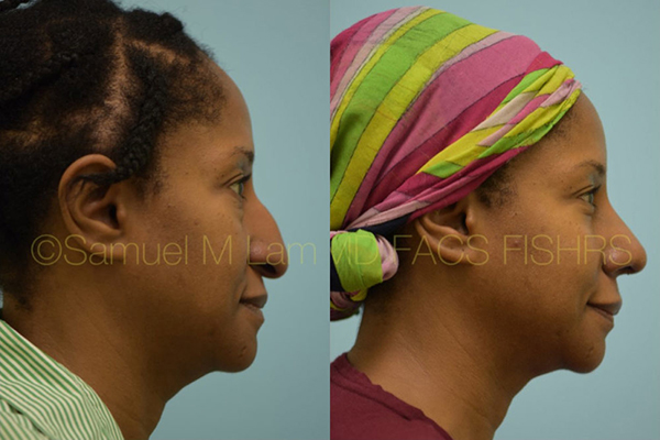 African American Rhinoplasty Before and After Dallas