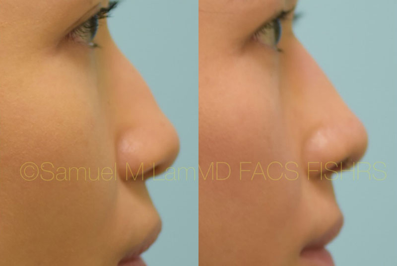 Asian Rhinoplasty asian rhinoplasty
