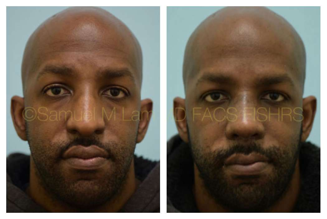 African American Rhinoplasty Before and After Dallas