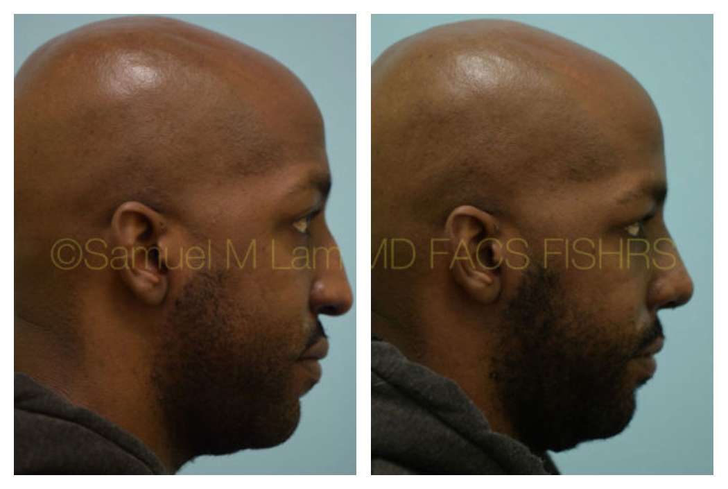 Male Rhinoplasty n Nasal Tip Results Dallas