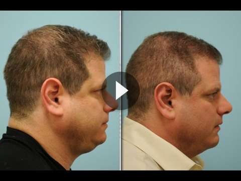 Male Rhinoplasty Videos