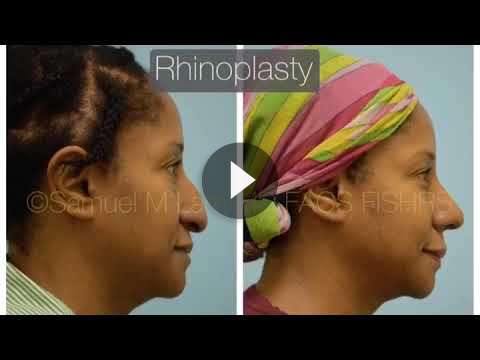 Nasal Tip Rhinoplasty Videos