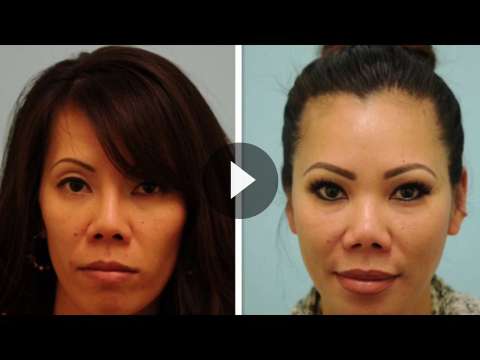 Asian Rhinoplasty Videos