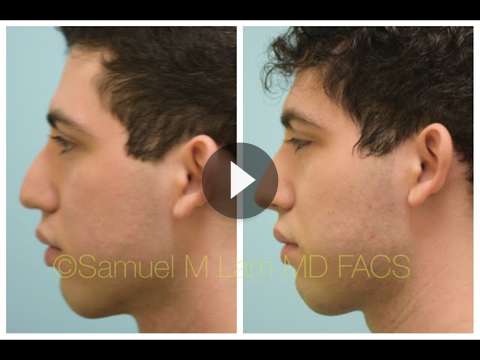 Male Rhinoplasty Videos