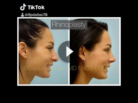 Traumatic Nose Rhinoplasty Videos