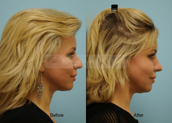 caucasian rhinoplasty patient