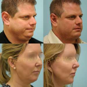 Chin Implant/Augmentation Rhinoplasty Dallas