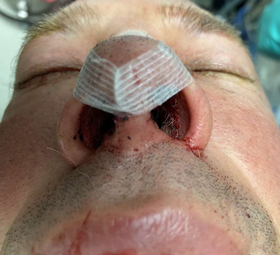 Crooked Nose Immediately After Surgery