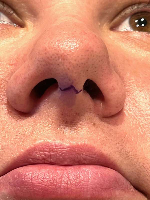 nasal incision