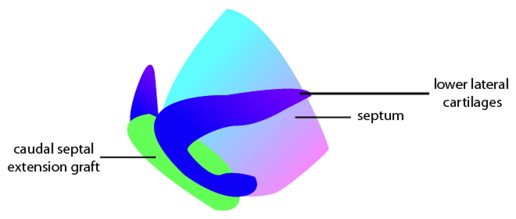 Caudal Septal Extension Graft