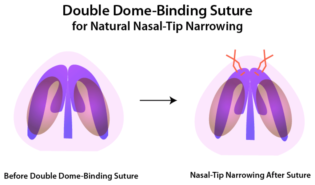 Double Dome-Binding Suture