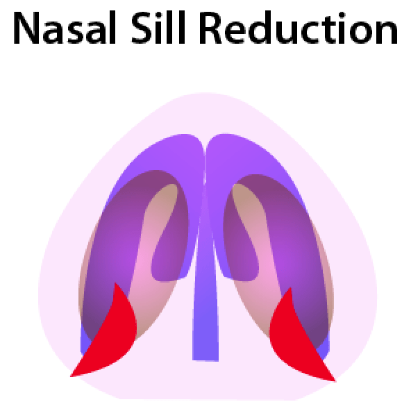Nasal-Sill Reduction