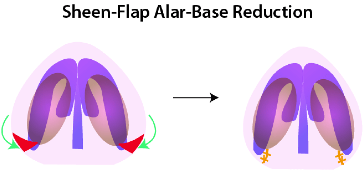 Sheen-Flap Alar-Base Reduction