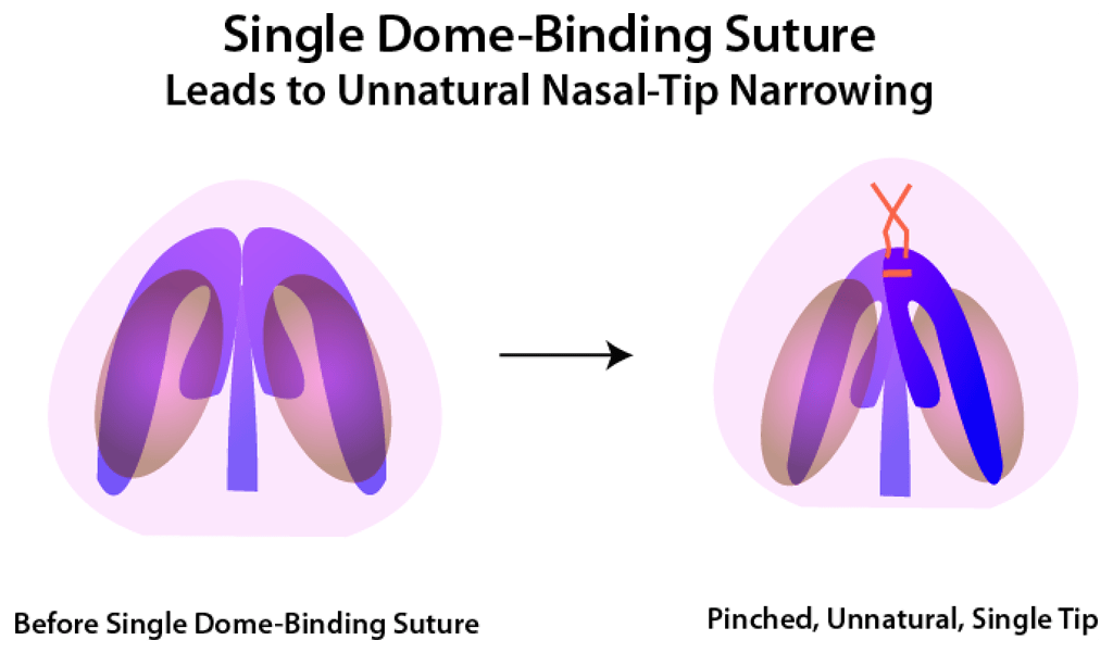 Single Dome-Binding Suture