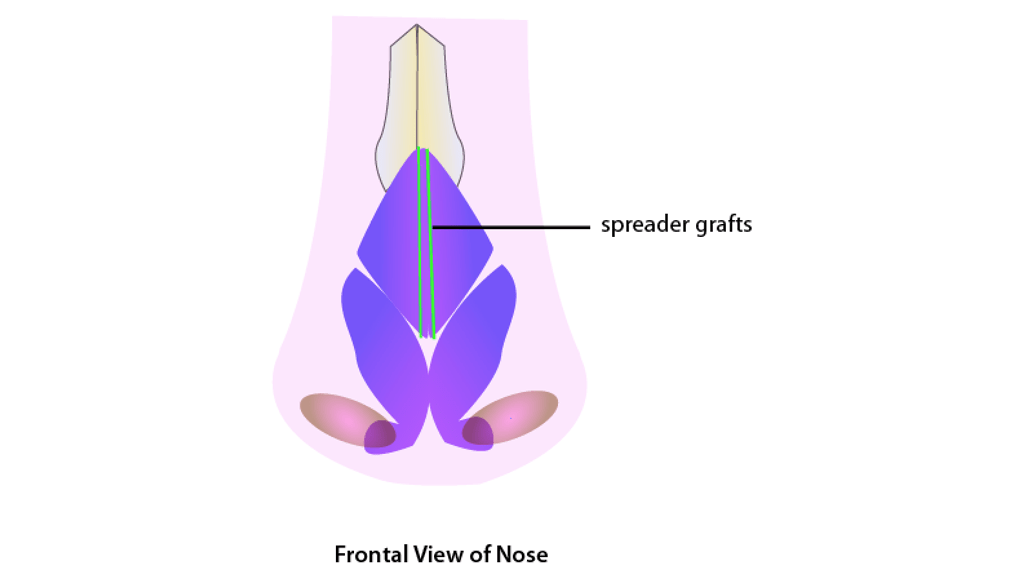 Spreader Graft