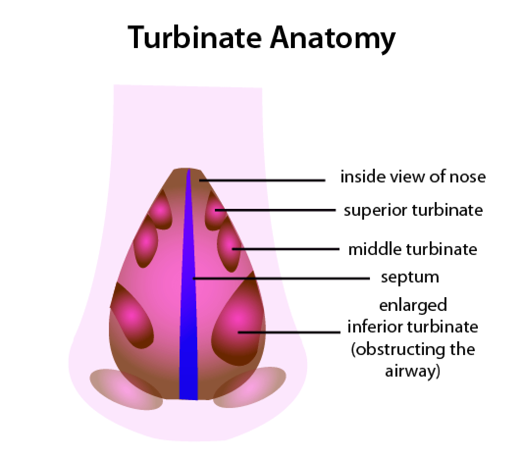 Enlarged Inferior Turbinate